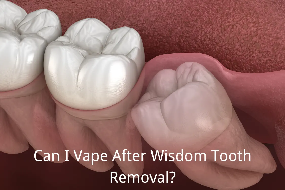 Can You Vape After Tooth Extraction: Essential Tips and Risks